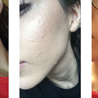 The Simple Skincare Routine That Helped Me Get Rid Of My Hormonal Acne